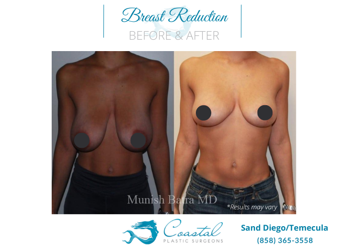 Before and after image showing the results of a breast reduction performed in San Diego, CA.