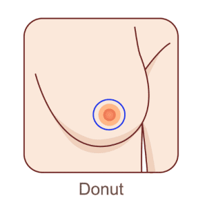 Illustration of the donut incision technique.