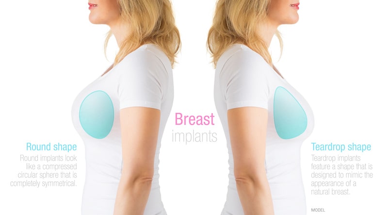 Illustration showing how round and shaped implants look in the breast.