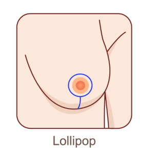 Illustration of the lollipop incision technique.