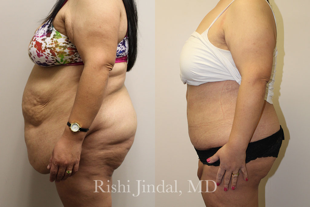 patient-484632a Before and after photos by Dr. Jindal, East County Coastal Plastic Surgeons