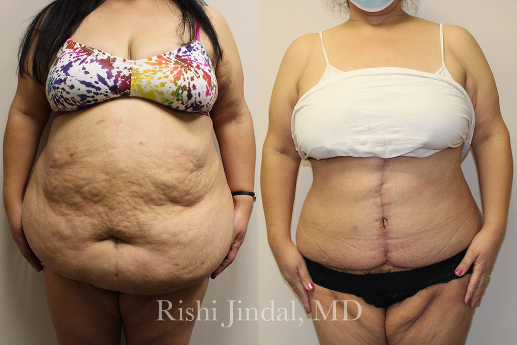 patient-484632b Before and after photos by Dr. Jindal, East County Coastal Plastic Surgeons