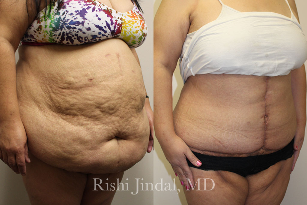 patient-484632c Before and after photos by Dr. Jindal, East County Coastal Plastic Surgeons