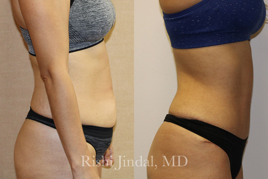 patient-558262a Before and after photos by Dr. Jindal, East County Coastal Plastic Surgeons
