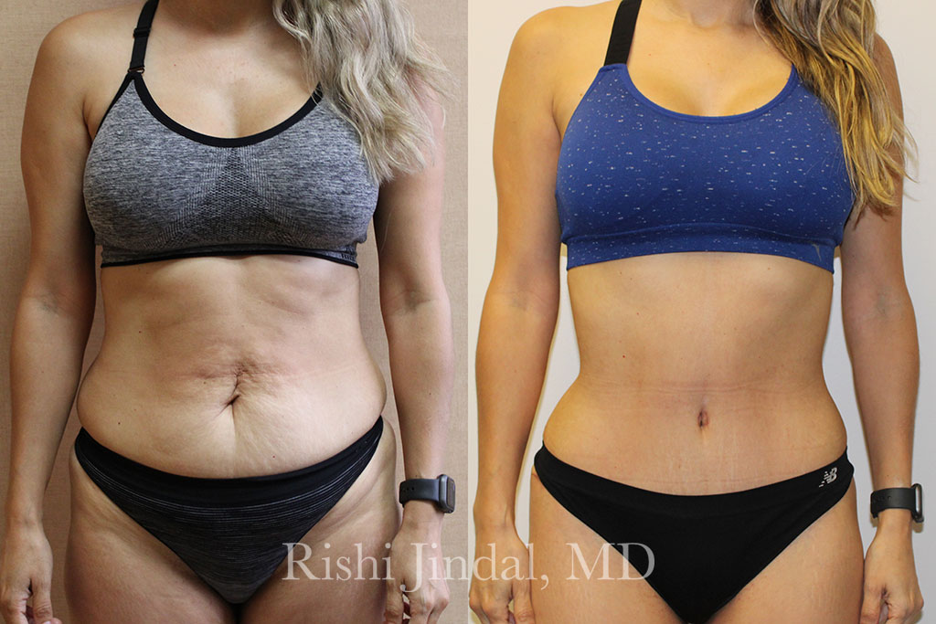 patient-558262b Before and after photos by Dr. Jindal, East County Coastal Plastic Surgeons