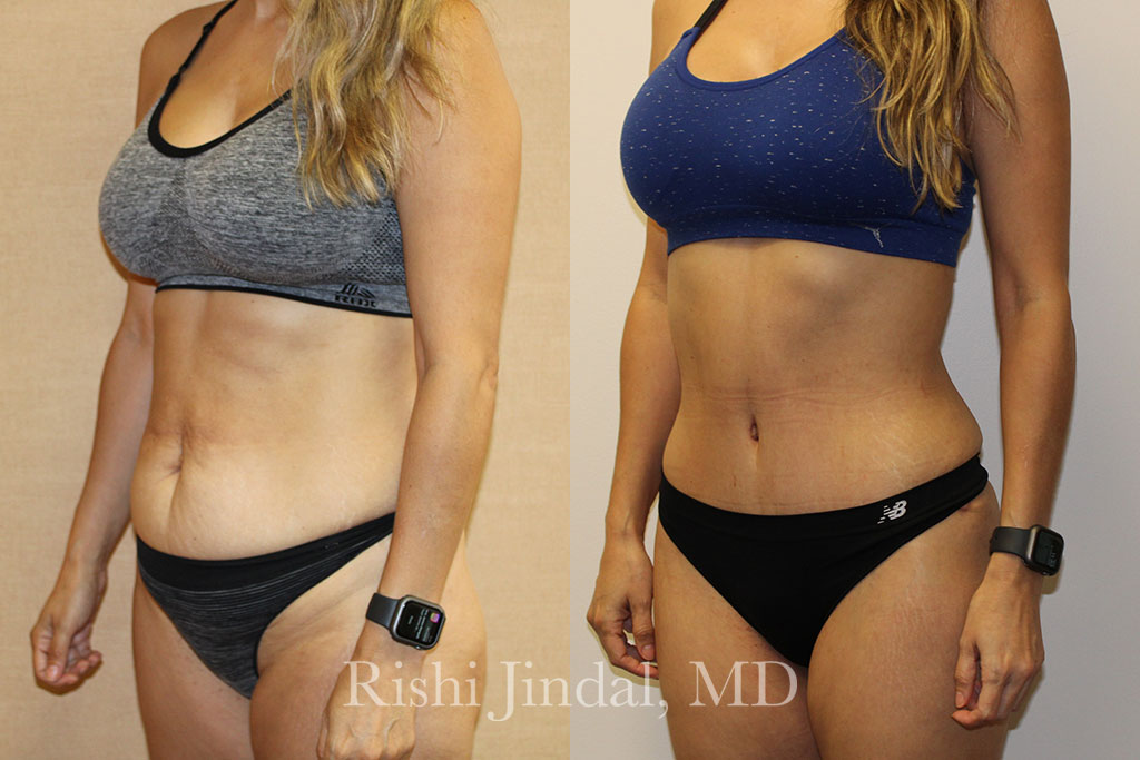 patient-558262c Before and after photos by Dr. Jindal, East County Coastal Plastic Surgeons