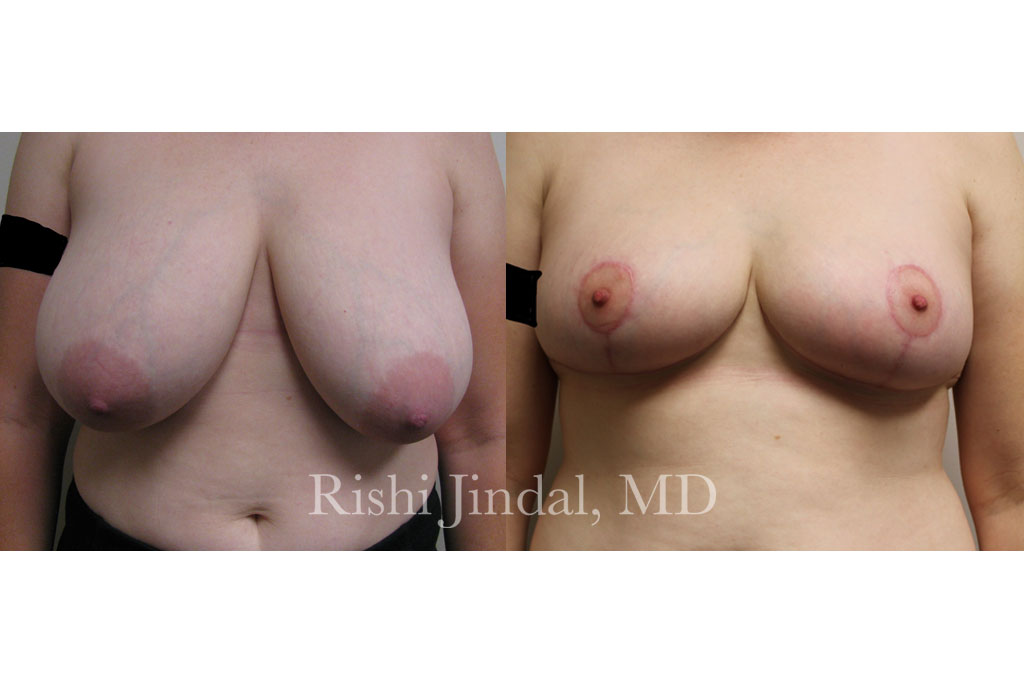 patient-12543a Before and after photos by Dr. Jindal, East County Coastal Plastic Surgeons
