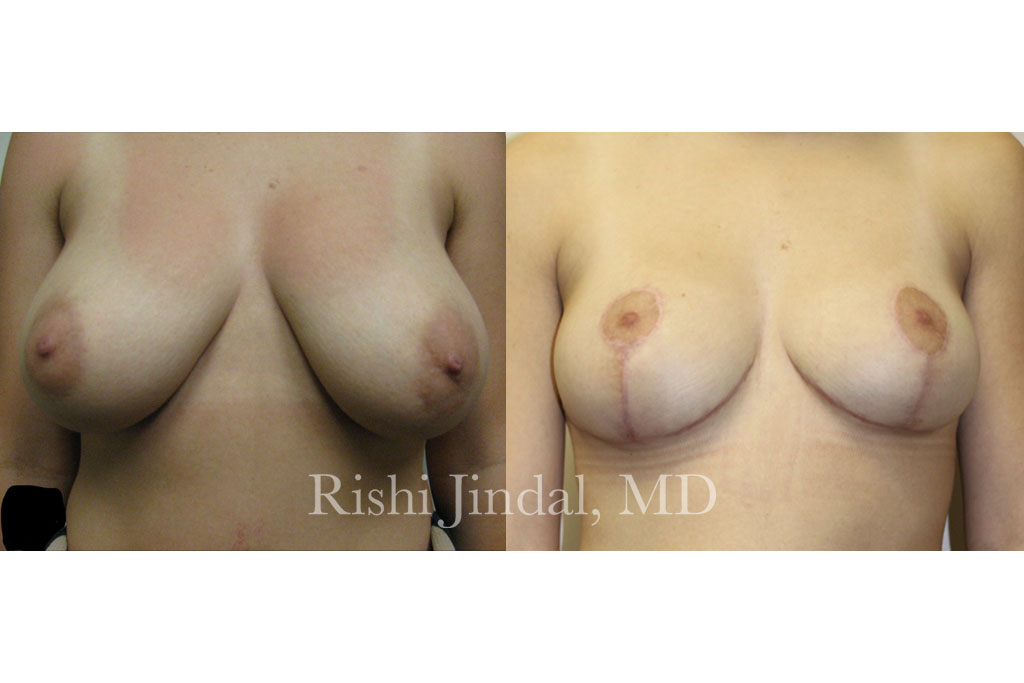 patient-32342a Before and after photos by Dr. Jindal, East County Coastal Plastic Surgeons