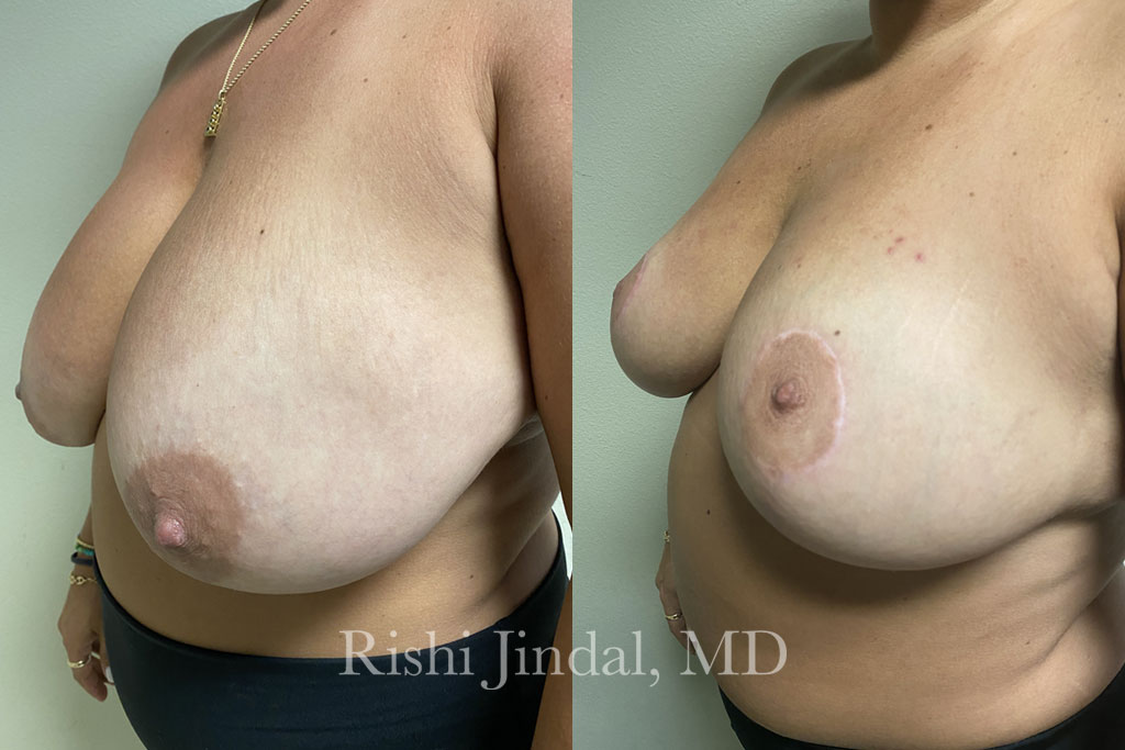 Before and after photos by Dr. Jindal, East County Coastal Plastic Surgeons