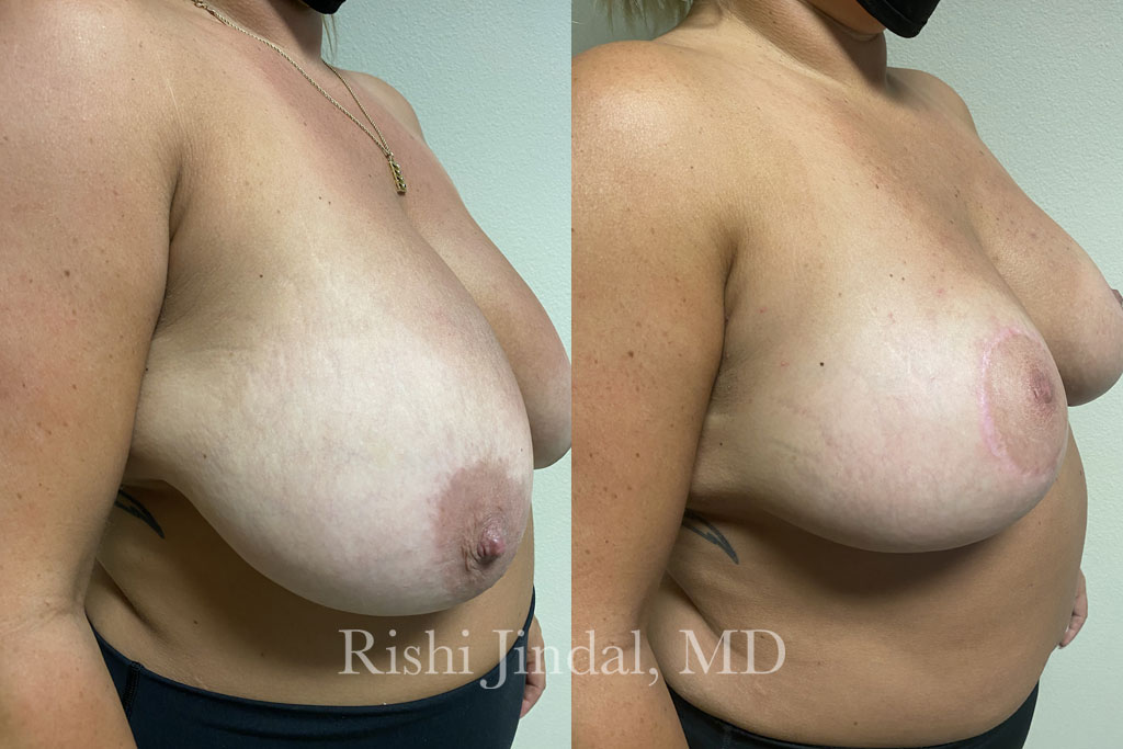 Before and after photos by Dr. Jindal, East County Coastal Plastic Surgeons