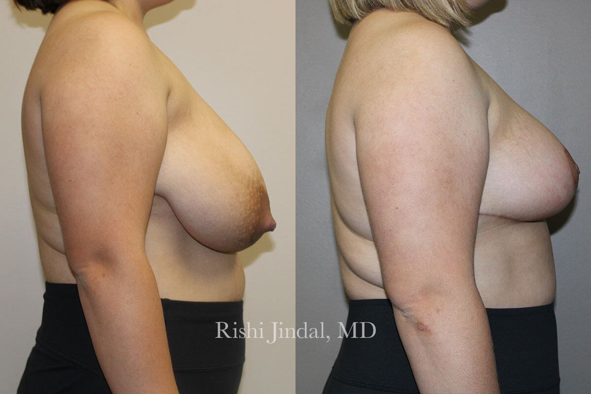 Before and after photos by Dr. Jindal, East County Coastal Plastic Surgeons