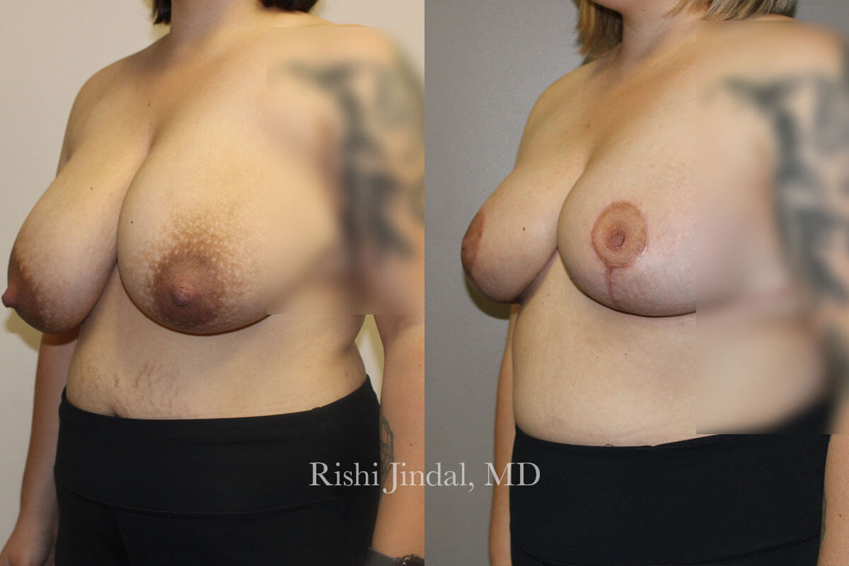 Before and after photos by Dr. Jindal, East County Coastal Plastic Surgeons