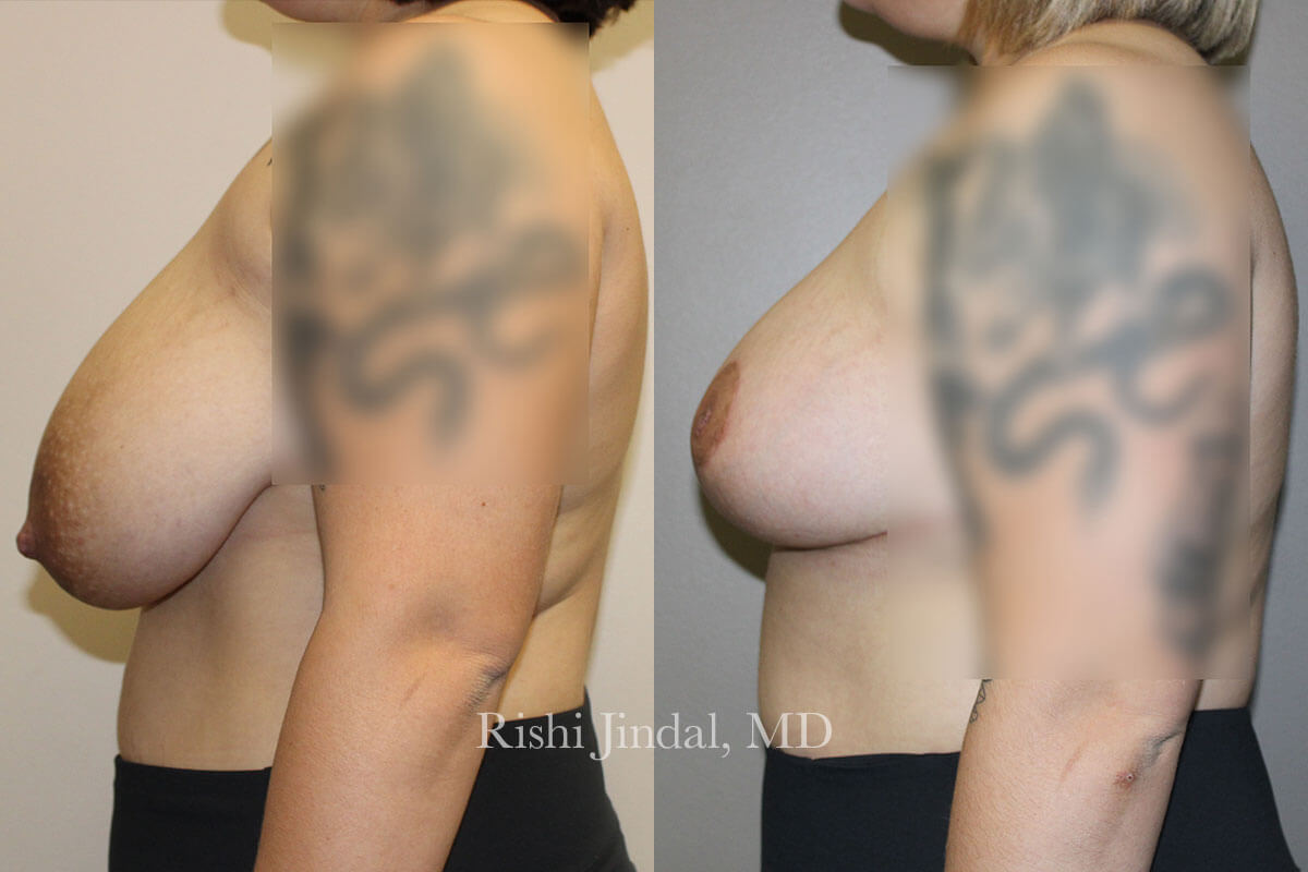 Before and after photos by Dr. Jindal, East County Coastal Plastic Surgeons