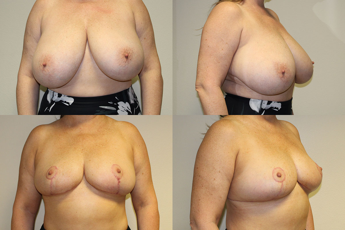 Before and after photos by Dr. Jindal, East County Coastal Plastic Surgeons