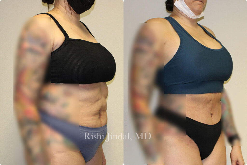 tummy-tuck-5 Before and after photos by Dr. Jindal, East County Coastal Plastic Surgeons