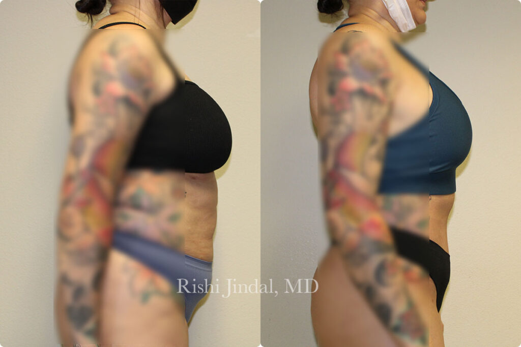 tummy-tuck-5 Before and after photos by Dr. Jindal, East County Coastal Plastic Surgeons
