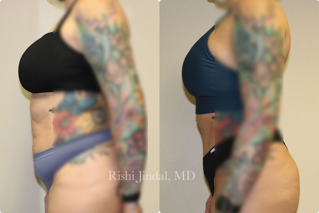 tummy-tuck-5 Before and after photos by Dr. Jindal, East County Coastal Plastic Surgeons