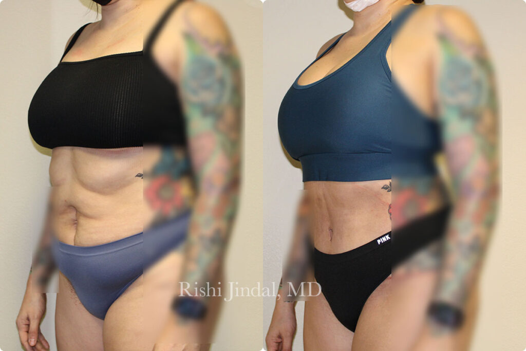 tummy-tuck-5 Before and after photos by Dr. Jindal, East County Coastal Plastic Surgeons