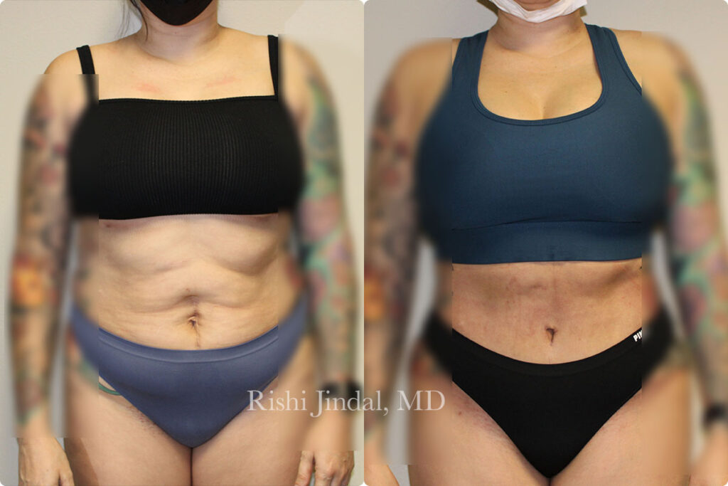 tummy-tuck-5 Before and after photos by Dr. Jindal, East County Coastal Plastic Surgeons