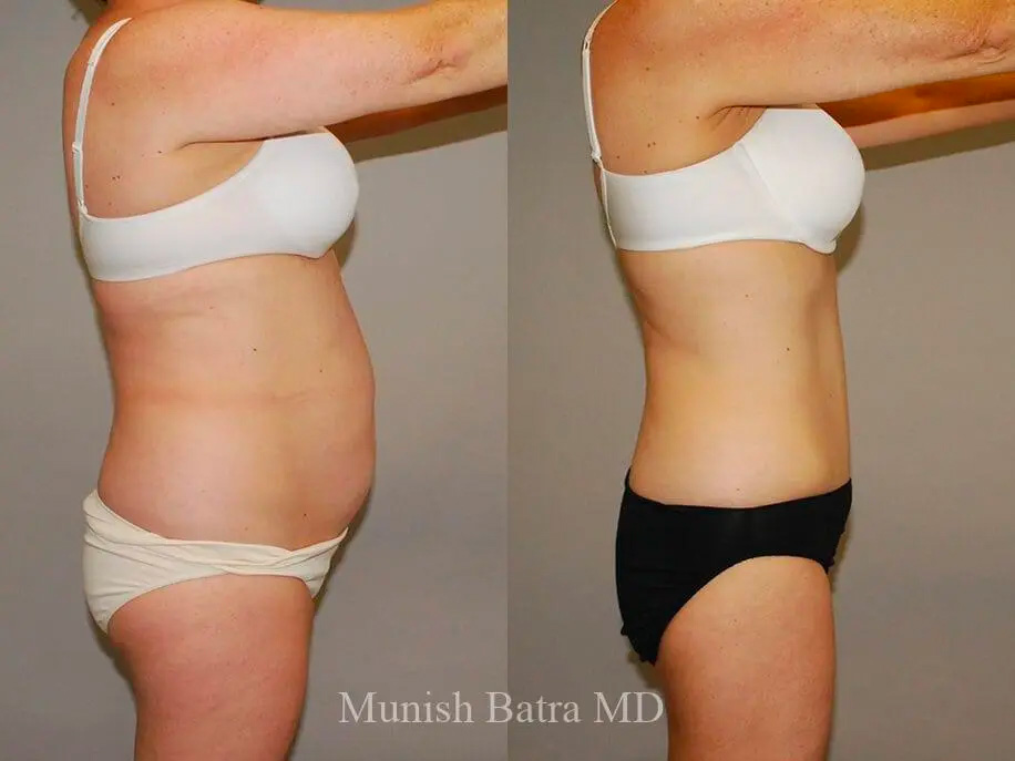 Before and after photos of a tummy tuck patient in San Diego, CA