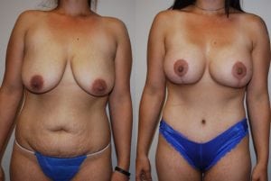 Before and After Image