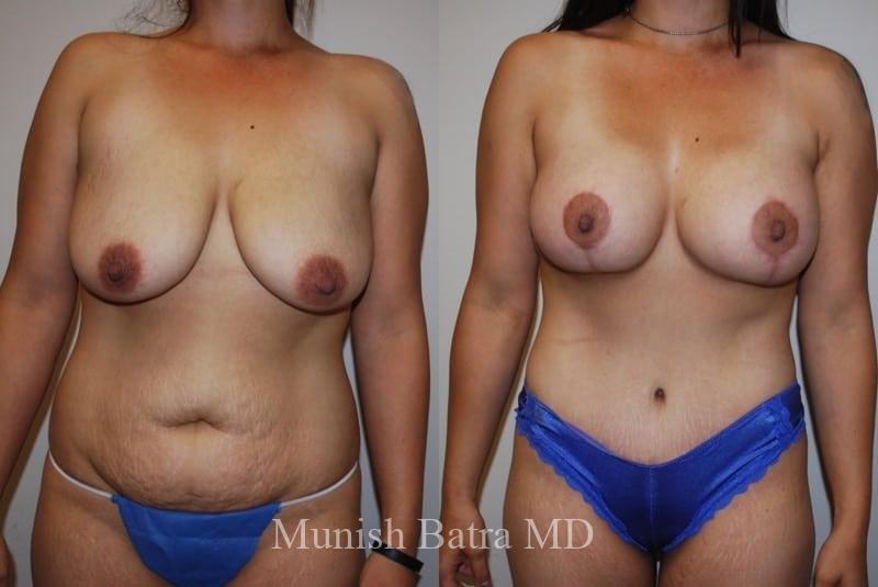 Before and After Image