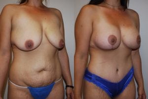 Before and After Image
