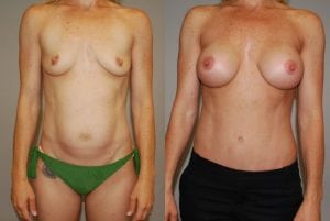Before and After Image