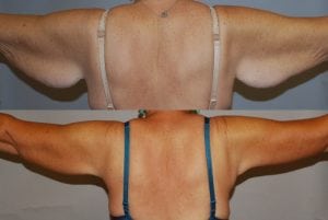 Before and After Image