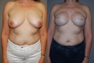 Before and After Image