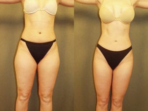 Before and After Image