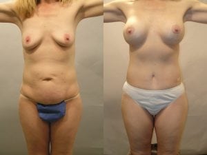 Before and After Image