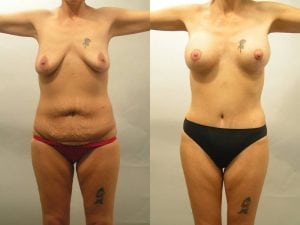Before and After Image
