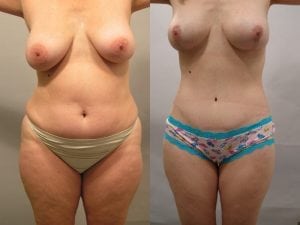 Before and After Image