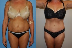 Before and After Image