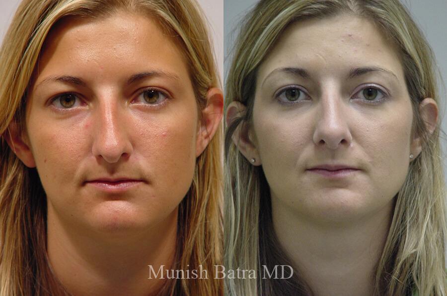 Before and After Image