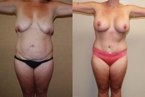 Before and After Image
