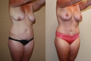 Before and After Image
