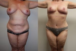 Before and After Image