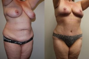 Before and After Image