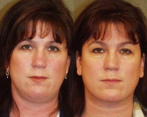 Before and After Image