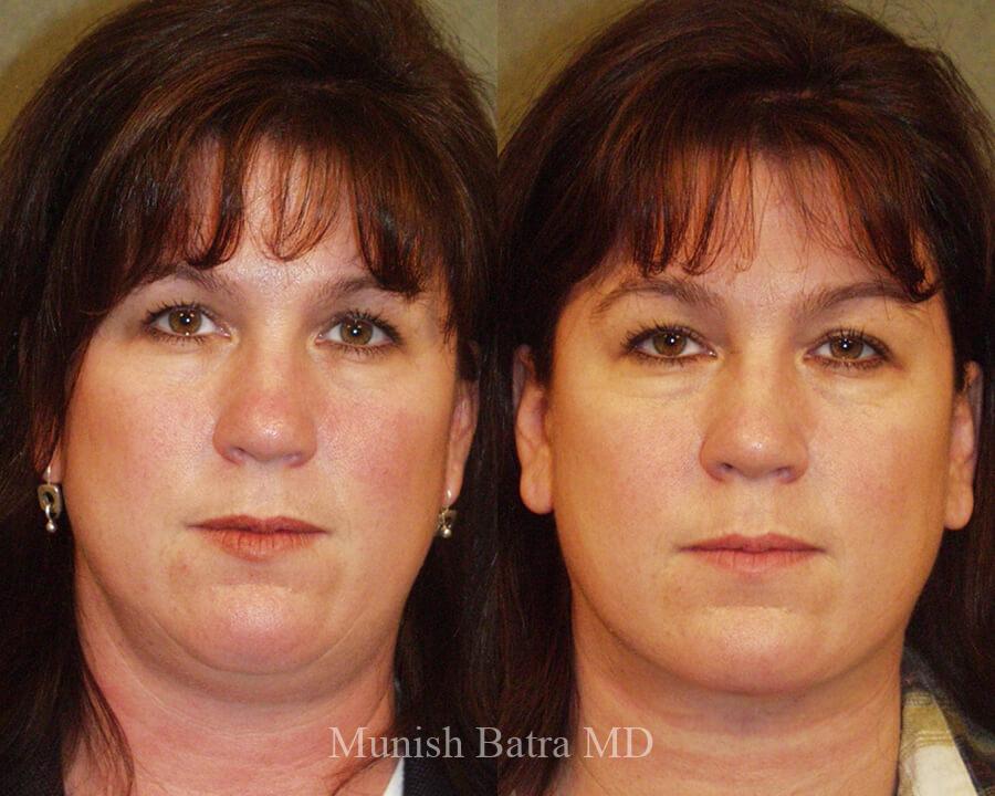 Before and After Image