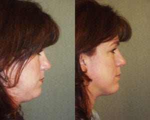 Before and After Image