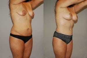 Before and After Image