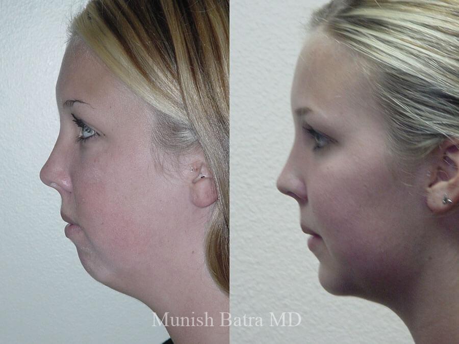Before and After Image