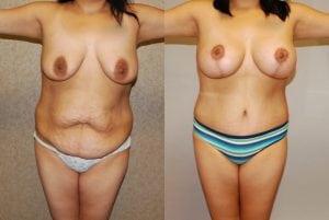 Before and After Image