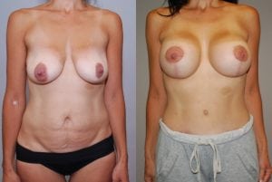 Before and After Image