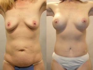 Before and After Image