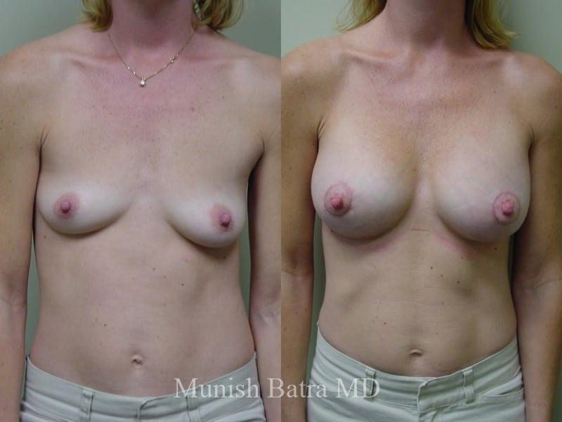 Before and after breast procedure results - patient 1