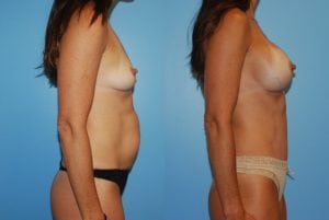 Before and After Image